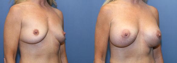 D cup size  DD cup size breast augmentation Beverly :HIlls